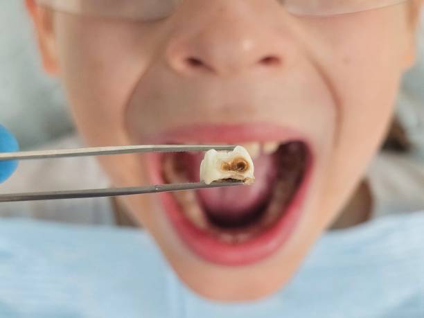 Best Emergency Dental Care for Sports Injuries in Louisville, GA